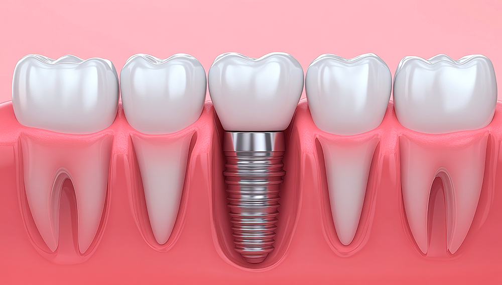 임플란트 의료보험적용대상