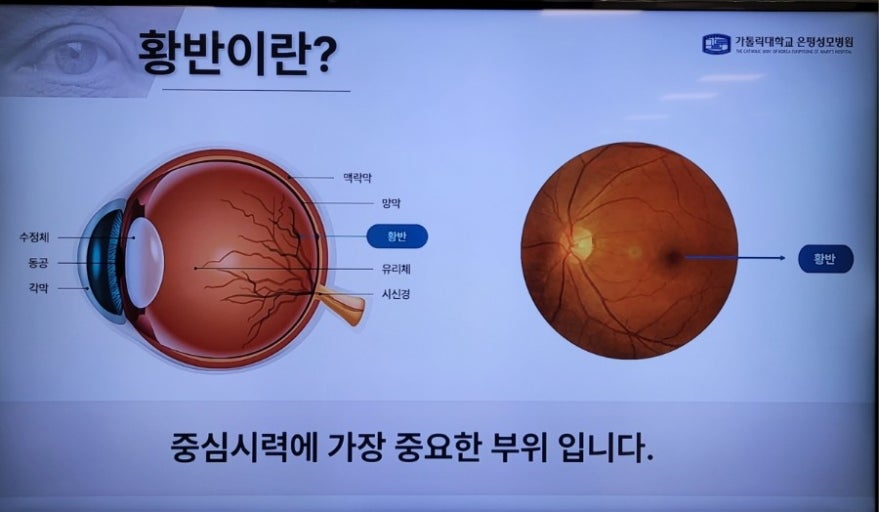 실명을 부르는 4대 망막질환 &ndash; 황반변성, 당뇨망막병증, 망막박리, 망막혈관폐쇄 총정리 관련 사진