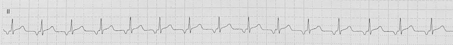 ectopic atrial tachycardia