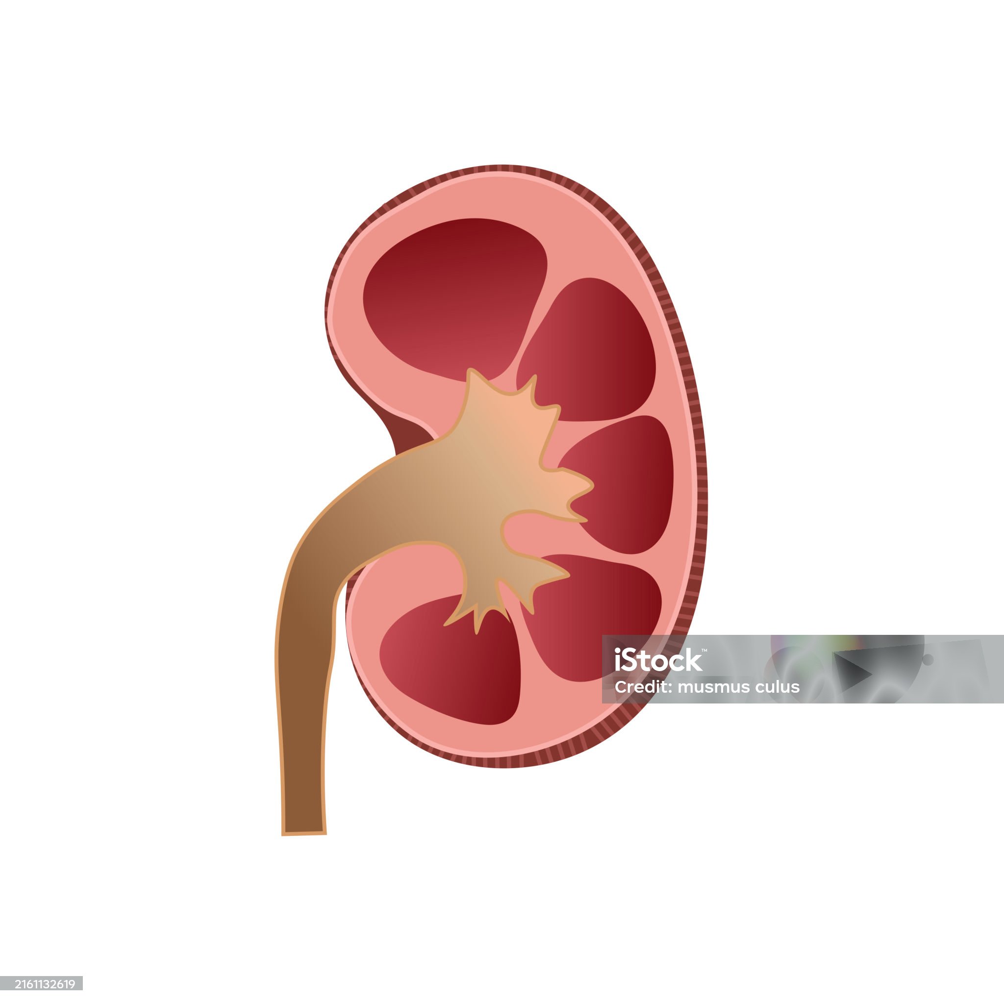 요로결석 관련 사진