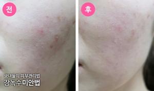 여드름 없애기