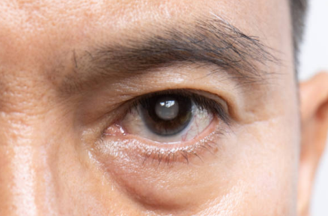 백내장 증상&amp;#44; 수술비용&amp;#44; 수술후 시력회복 기간 총정리 (2024ver)