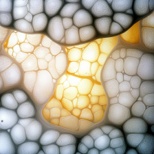 신장 혈관근지방종