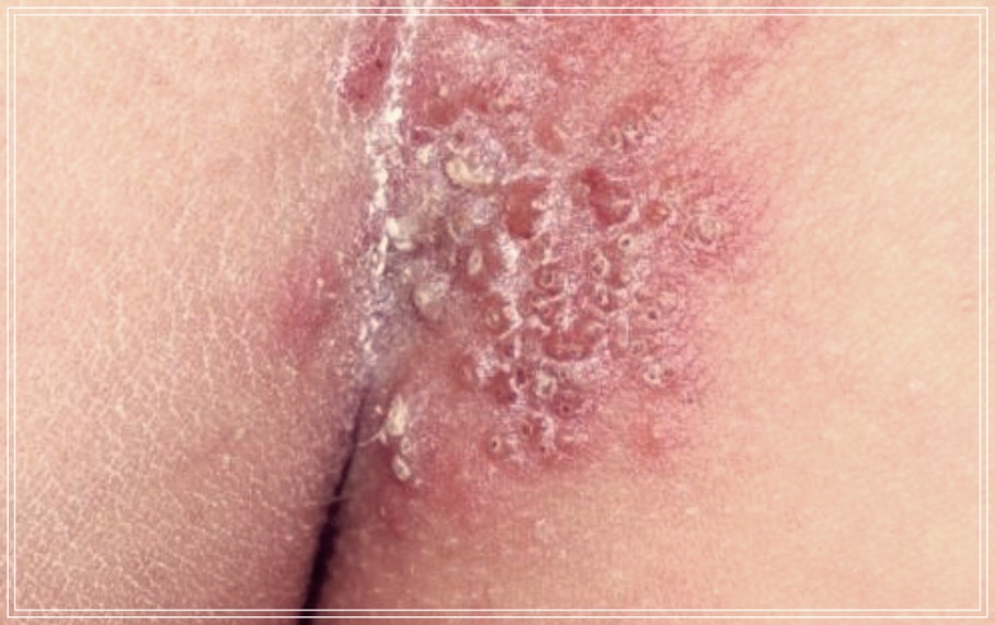 엉덩이 대상포진 초기 증상과 빨리 낳는 방법