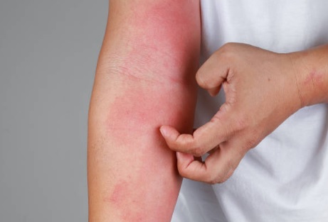 피부-가려움증-원인-설명하는-사진