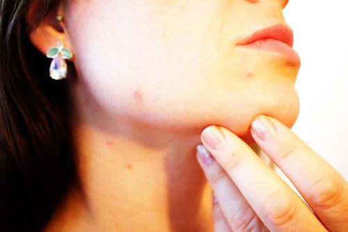 종기가 생기는 이유