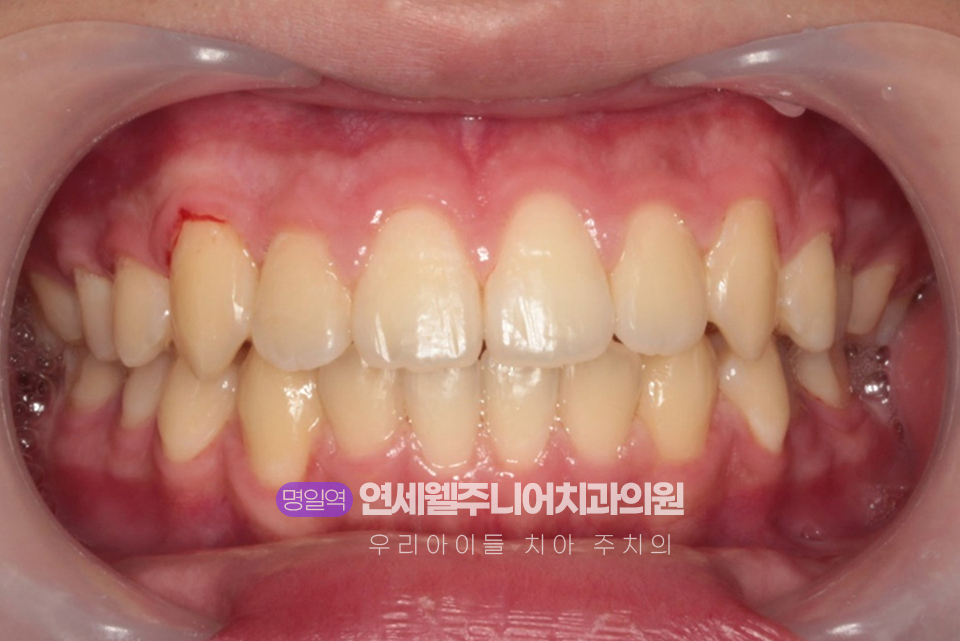 개방교합 교정 후 위아래 앞니 사이의 공간이 줄어들고 앞니 맞물림이 개선된 구강 사진