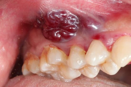 구강암 (Oral Cavity Cancer)의 원인과 치료