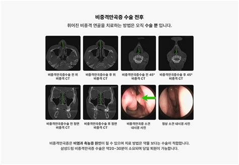 비중격코수술