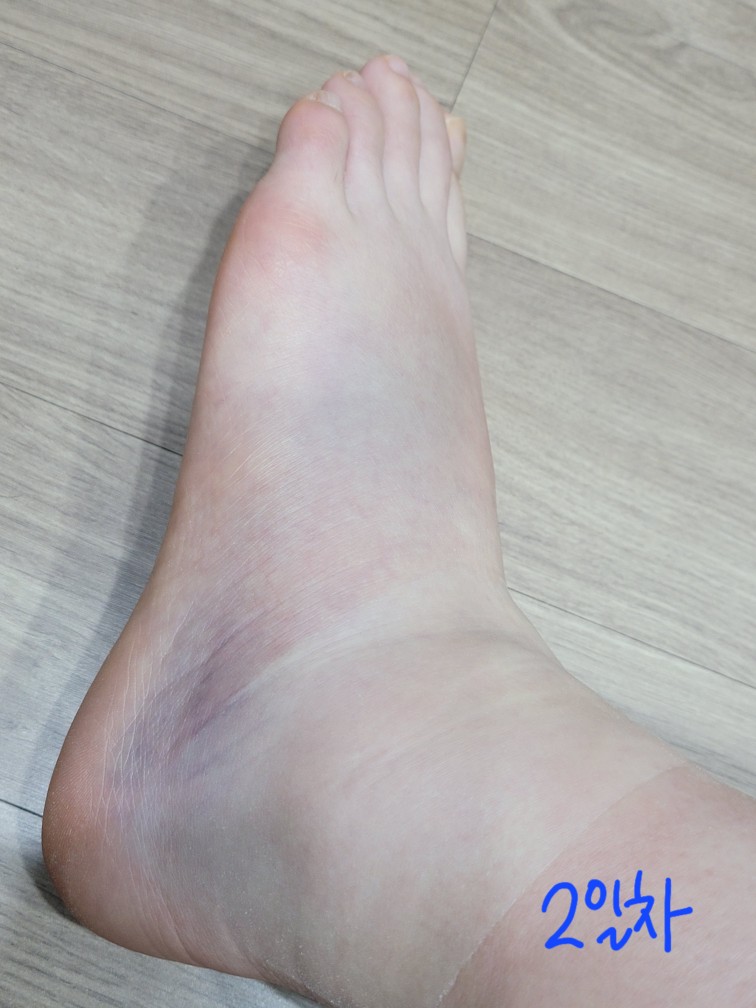 발목-접질렀을-때