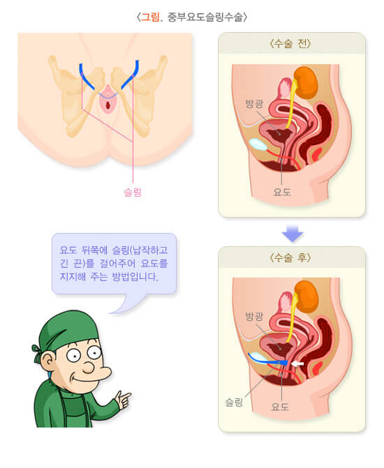 요실금 치료방법&amp;#44; 요실금 수술 비용&amp;#44; 요실금 팬티&amp;#44; 요실금 치료기 추천&amp;#44; 요실금 병원