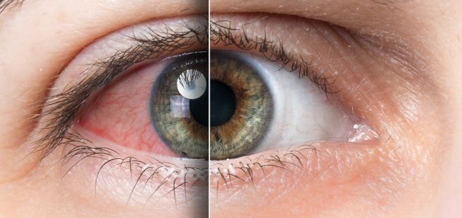 눈이 충혈되는 이유