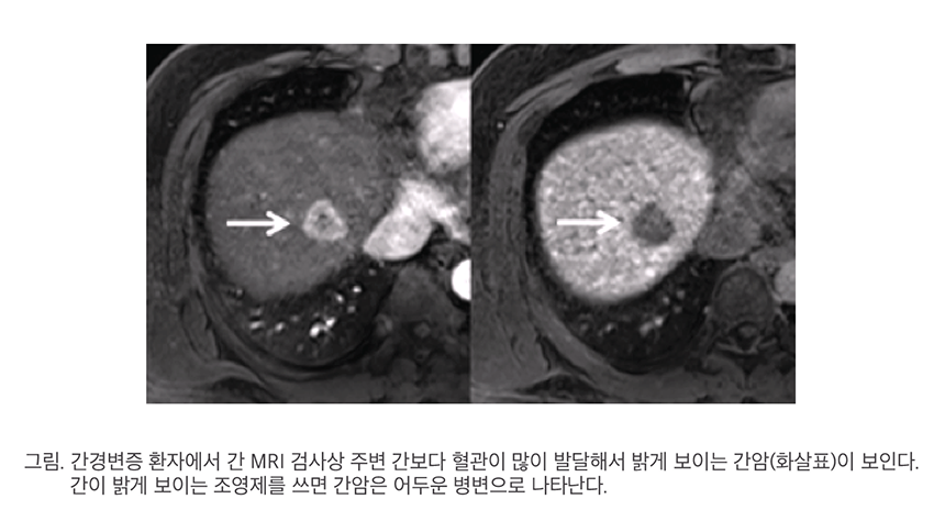 비만으로 간암까지? 술 안 마셔도 위험합니다