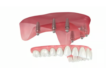 전체 임플란트 단점