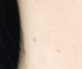 사마귀 원인과 제거방법