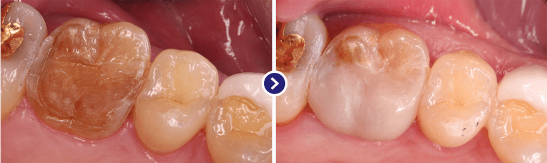 미니쉬 치료 과정