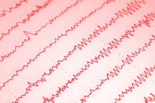 뇌전증 환자의 뇌파 모습