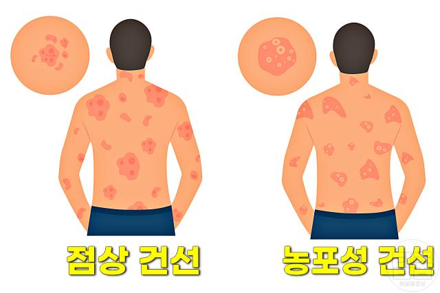 건선에 좋은 음식 건선식단 추천