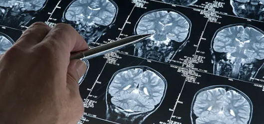 뇌종양 초기증상 1