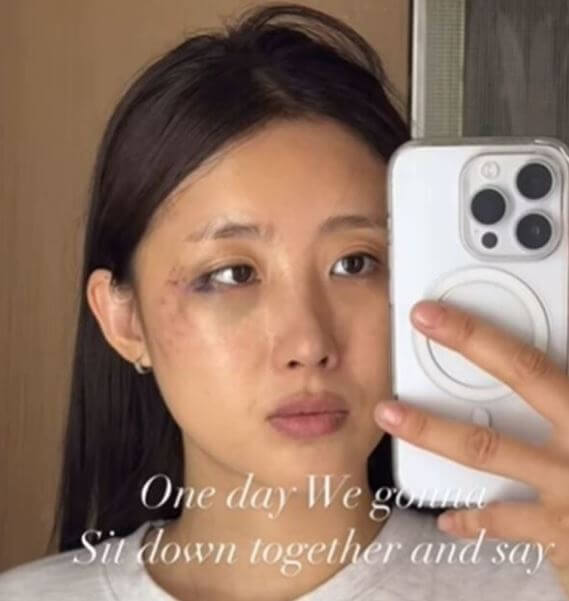 나인뮤지스 현아 낙마사고