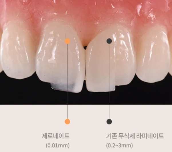 제로네이트,제로네이트 가격,제로네이트 부작용,제로네이트 뜻,무삭제 라미네이트,라미네이트 후기