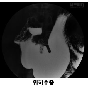 위하수증