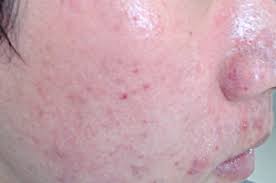 지루성 피부염 완치하려면