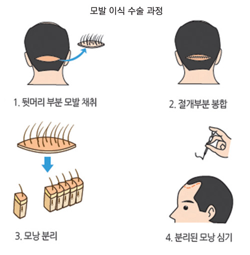 모발이식-수술-과정