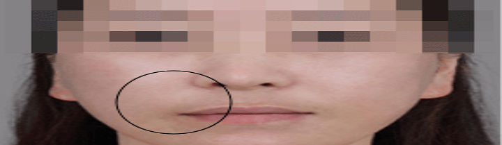 물광주사 맞은 후 사진