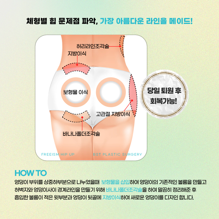 엉덩이 부위를 상중하부분으로 나누었을 때 보형물을 삽입하여 엉덩이의 기본적인 볼륨을 만들고 허벅지 엉덩이사이 경계라인을 만들기 위해 바나나폴더조각술을 하여 말끔히 정리해준 후 흡입한 볼륨이 적은 윗부분과 엉덩이 뒷골에 지방이식하여 새로운 엉덩이를 디자인합니다.