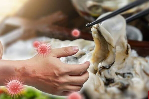 비브리오-패혈증-증상