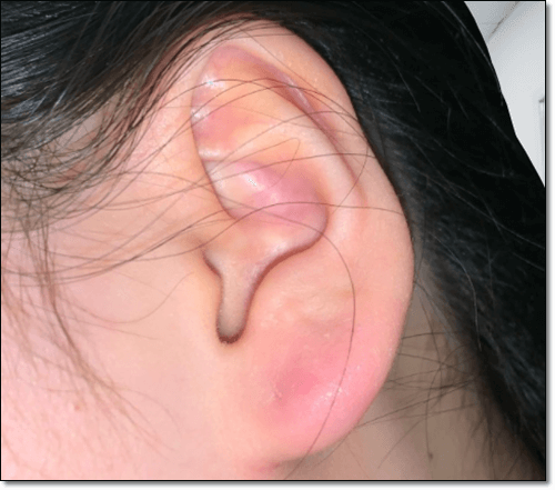 귓볼몽우리 증상