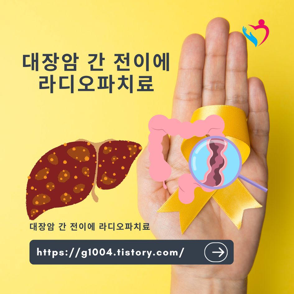 대장암 간 전이에 라디오파치료