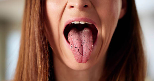 혓바닥이 갈라지는 이유, 혹시 영양 결핍 때문일까?