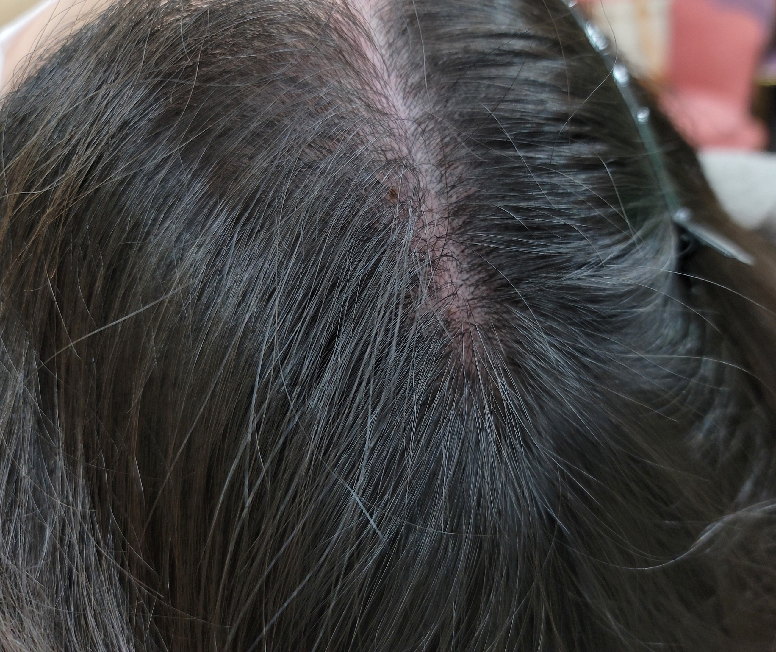 다양한 원인과 증상 여성 탈모