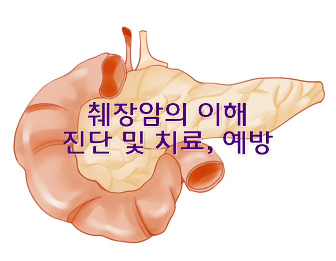 췌장암의 이해, 진단 및 치료, 예방