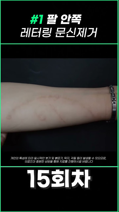기미 없애는 방법