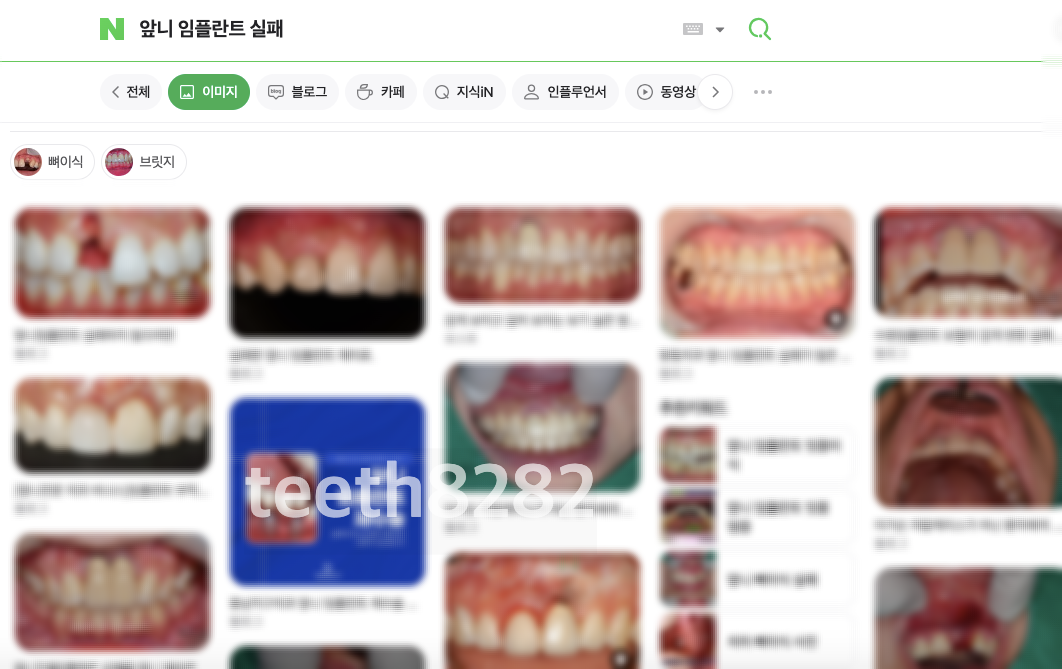 앞니-임플란트-실패