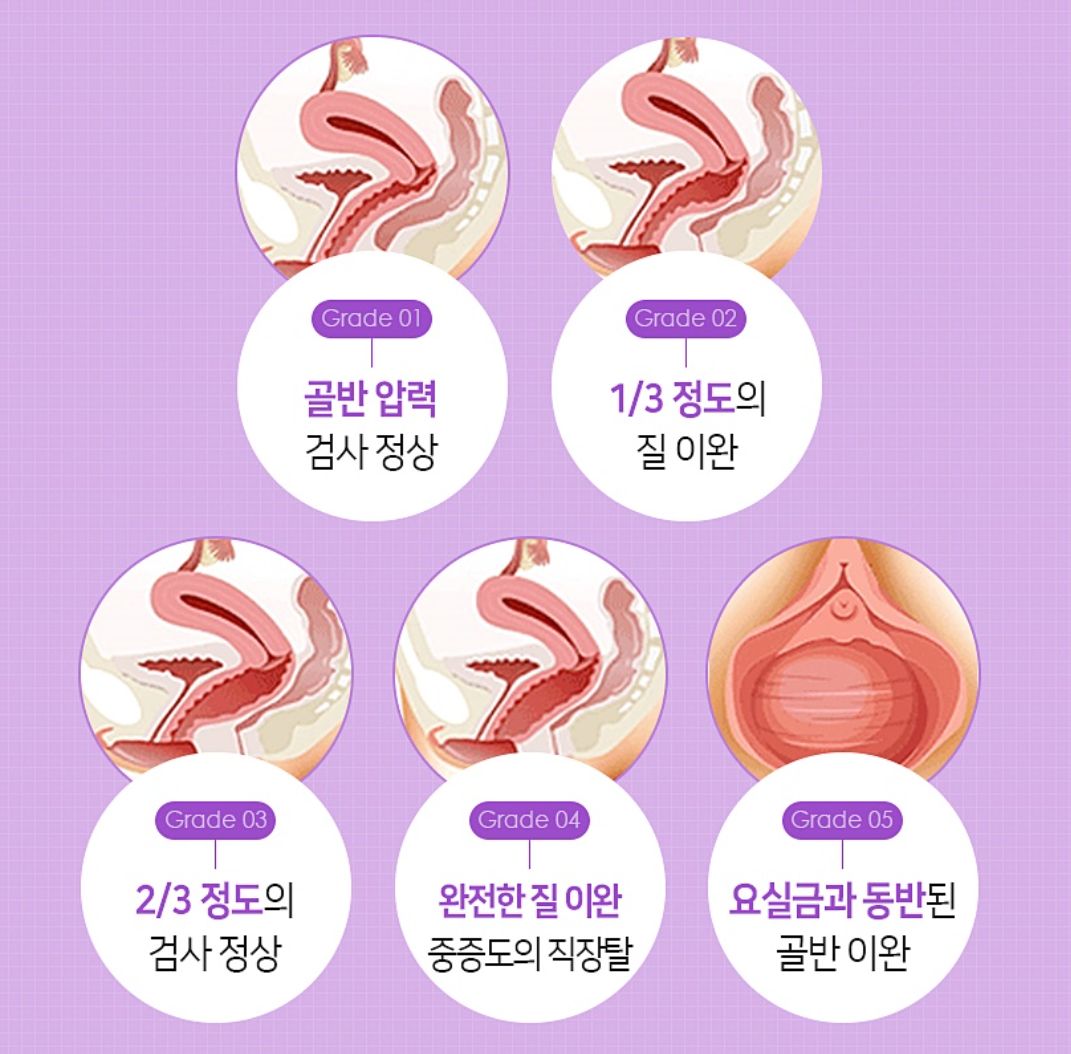 질이완증 / 질 이완 증상, 노화일까? / 질이완증 체크리스트 / 방치하면 생기는 문제와 해결 방법