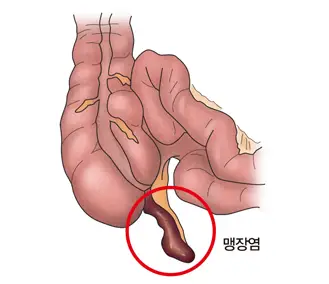 맹장염