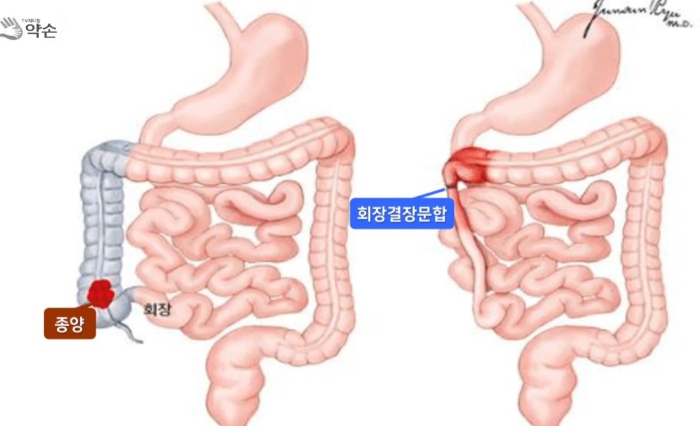 EBS명의-직장암-항문-명의-김진-교수