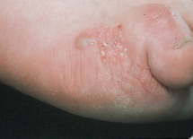 무좀 증상별 무좀약 추천