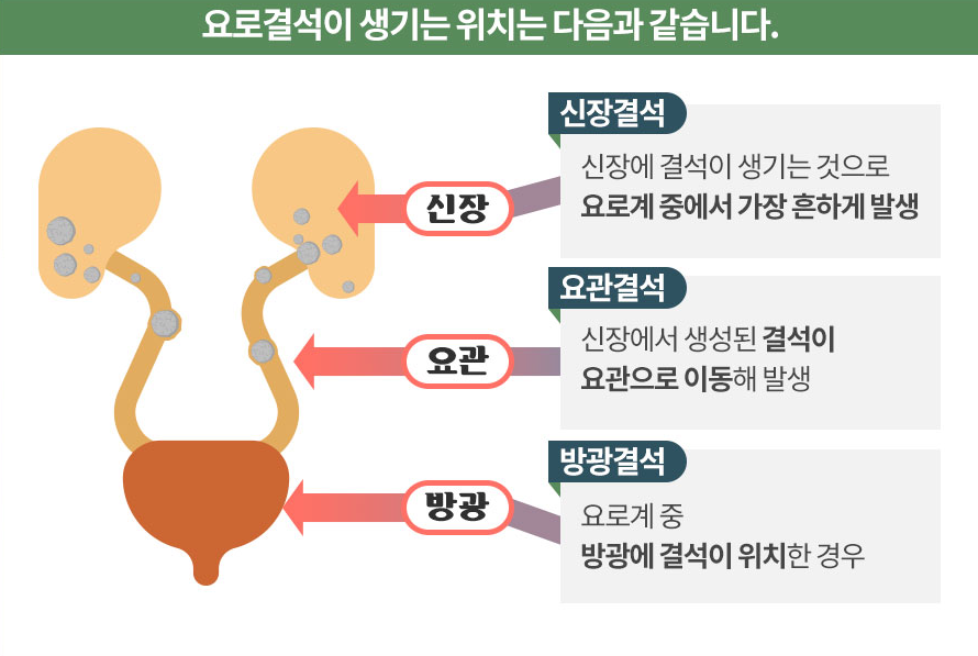 요로결석 증상, 원인, 치료방법