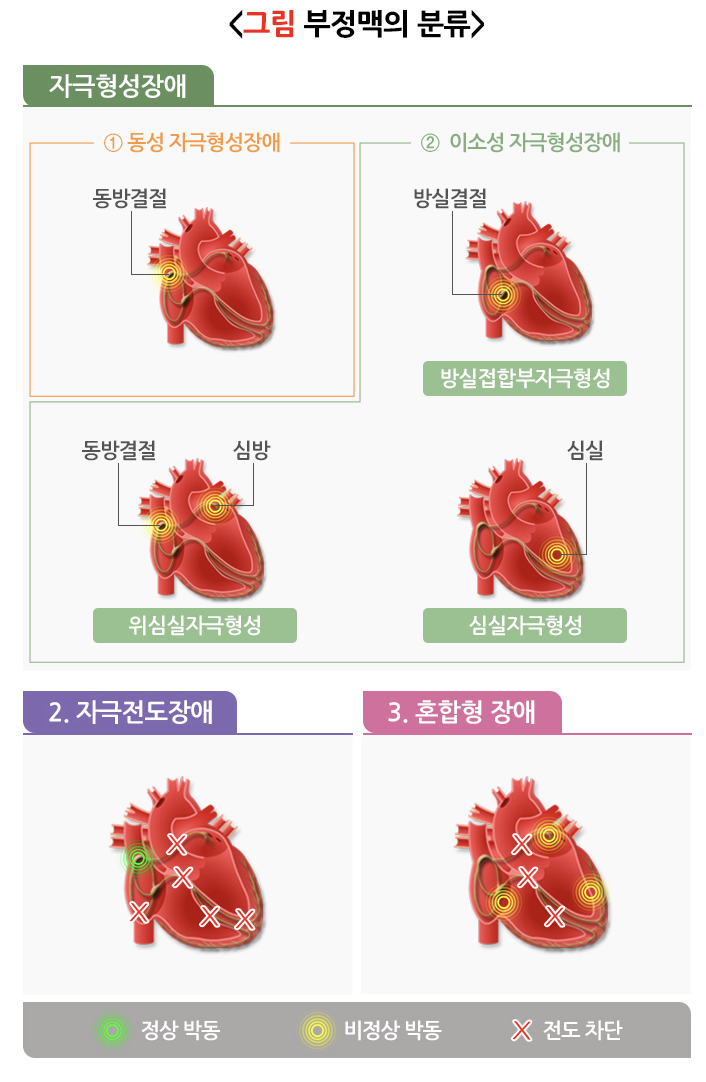 부정맥의 분류