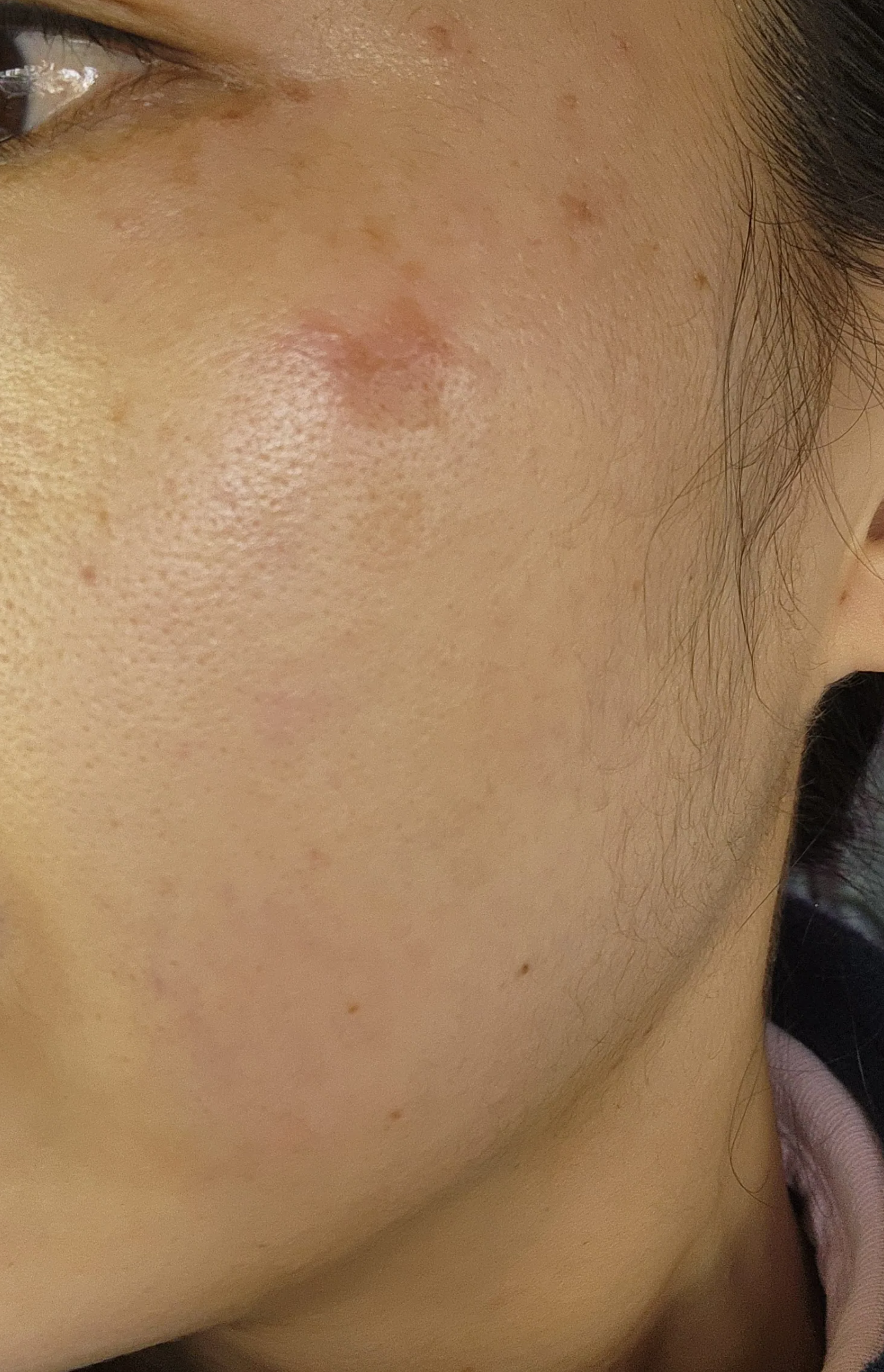 흑자 엑셀V시술 직후 흑자가 빨갛게 변함