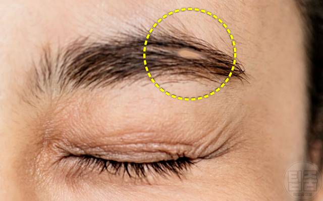 피부병 눈썹 빠짐 탈모 호르몬불균형 갑상선기능저하증