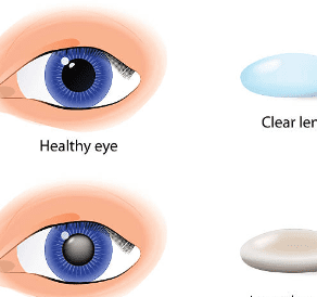 백내장 수술비용