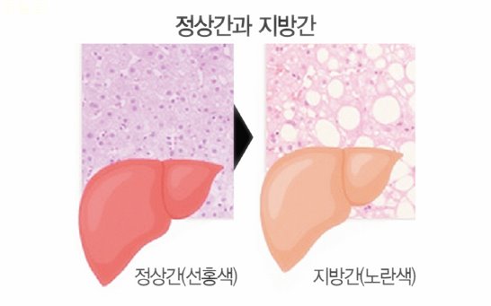 지방간 없애는 방법