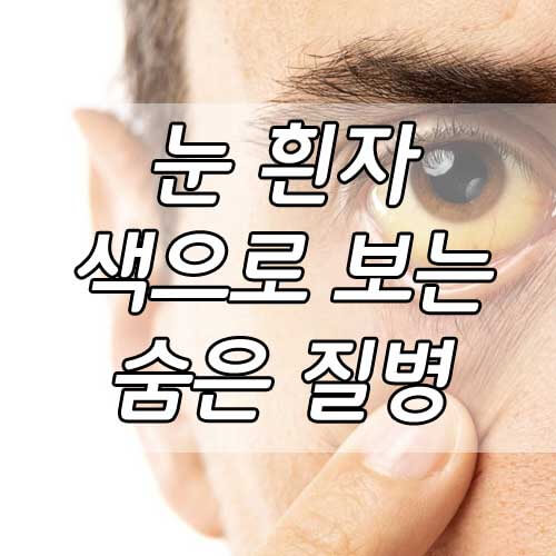 눈흰자 노란색, 눈 상태로 보는 내 몸속의 숨은 질병 찾기 6가지!