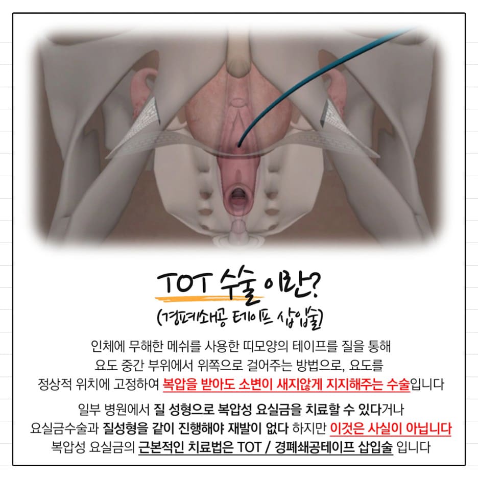 요실금약
요실금운동
요실금수술